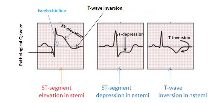 hkg inf-nstemi-vs-stemi-ECG